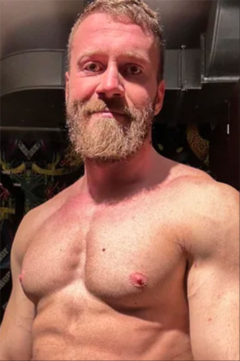 The Vitiligo Viking